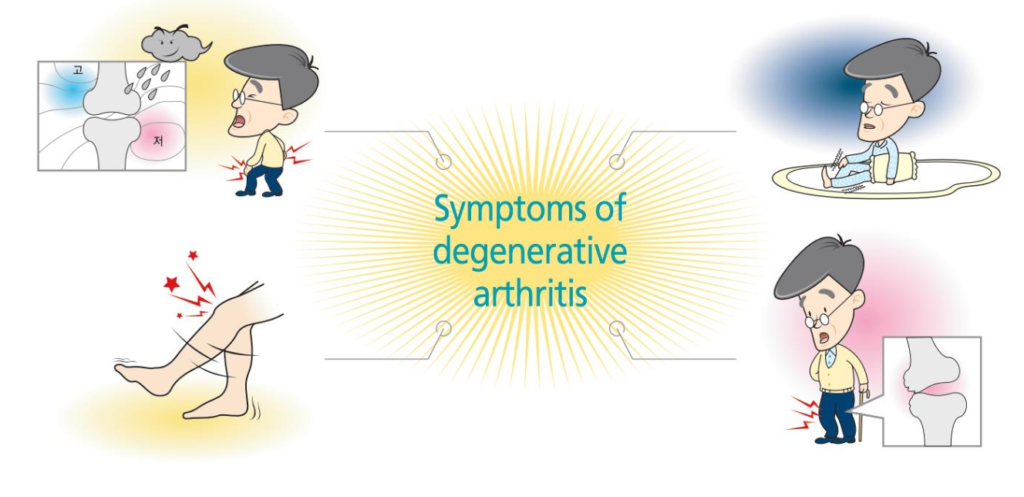 Symptoms of degenerative arthiritis image